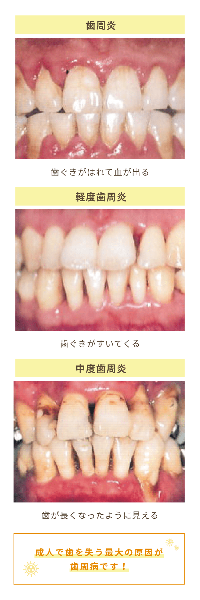 成人で歯を失う最大の原因が歯周病です